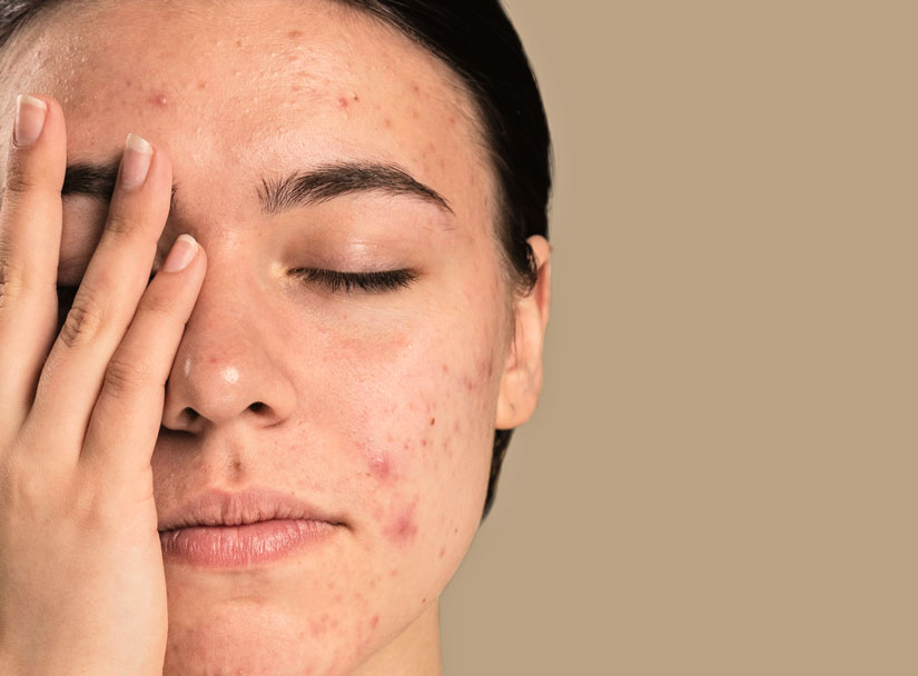 Qué es el acné, causas y síntomas I Cosmetics Herbera